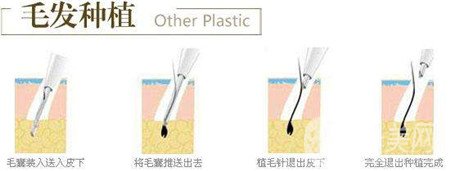 毛發(fā)種植費用大概要多少錢？