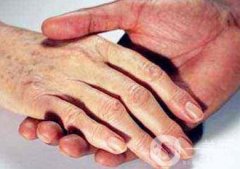 怎樣去掉手上的老年斑？還會再生嗎？