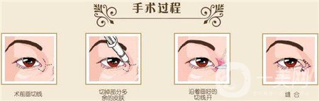 韓式開眼角多少錢？普遍價位是多少？