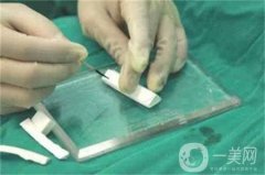 膨體隆鼻缺點是什么？優(yōu)點有哪些？