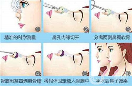 膨體隆鼻術(shù)后注意事項有哪些？需要忌口嗎？