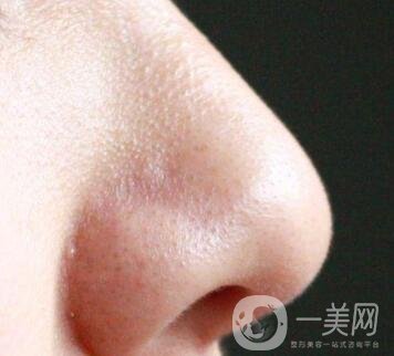 鼻子長黑頭怎么辦？做激光有用嗎？