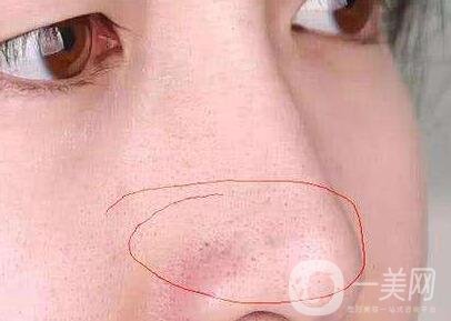 鼻子長黑頭怎么辦？做激光有用嗎？