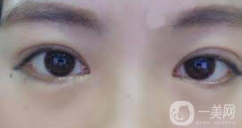 韓式微創(chuàng)雙眼皮手術