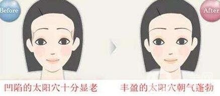 濟(jì)南自體脂肪填充太陽穴價(jià)格貴不貴?