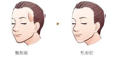 濟(jì)南自體脂肪填充太陽穴價(jià)格貴不貴?