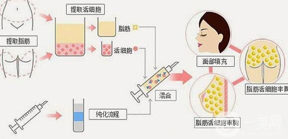 自體脂肪填充的價格是怎么計費(fèi)的?