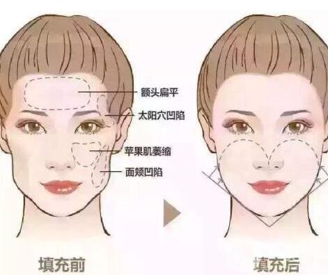 自體脂肪填充價(jià)格大概要多少錢(qián)?