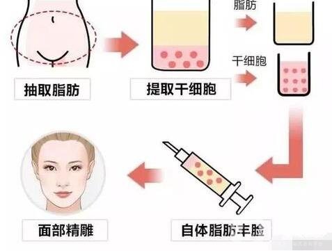 自體脂肪填充術(shù)前檢查及術(shù)后護(hù)理事項(xiàng)