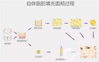 北京自體脂肪填充醫(yī)院有哪些？好的有哪些？