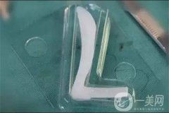 假體隆鼻果如何？多久可以看到果呢？