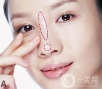 無假體隆鼻是什么情況?怎么做的?