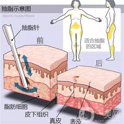 腰腹環(huán)吸后要腫多長(zhǎng)時(shí)間呢？可以活動(dòng)嗎？