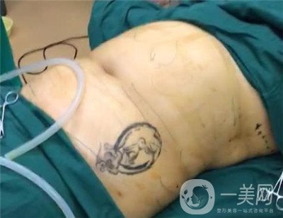 腰腹環(huán)吸后要腫多長(zhǎng)時(shí)間呢？可以活動(dòng)嗎？