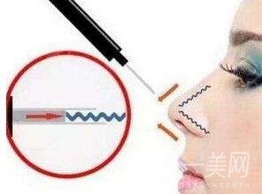 自體軟骨隆鼻整形疼嗎？*嗎？
