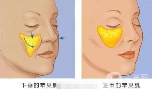 注射填充蘋果肌之后能笑嗎?會(huì)僵硬嗎?