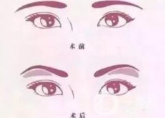 玻尿酸眉弓填充怎么打？會(huì)下滑嗎？