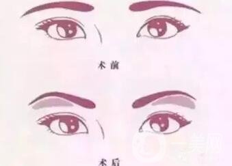 玻尿酸眉弓填充怎么打？會(huì)下滑嗎？