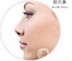 朝天鼻怎么整形？手術(shù)神秘面紗揭幕
