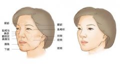 自體脂肪填充要注意什么?術后怎么護理?