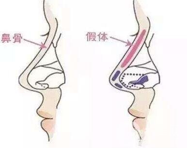 假體隆鼻需要多少錢(qián)?進(jìn)口的要多少錢(qián)?