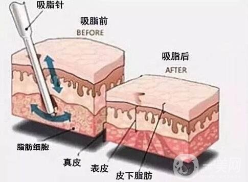 大腿吸脂第五天開(kāi)始爆腫是醫(yī)生打腫脹液的緣故嗎?