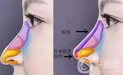 北京整容墊鼻梁多少錢？附隆鼻價(jià)格明細(xì)一覽表