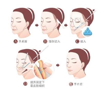 下筋膜懸吊祛皺術(shù)怎么操作的？*果嗎？