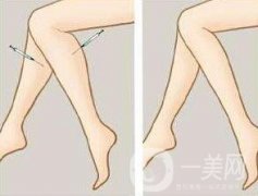 注射瘦臉瘦小腿一般多少錢(qián)？