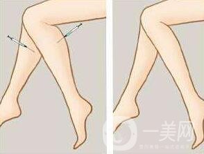 *瘦小腿一般多少錢？
