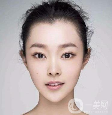 膨體隆下巴多久會變軟？容易取出來嗎？