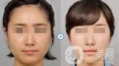 打*臉會腫嗎？恢復(fù)期要多久？