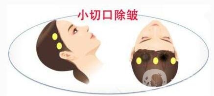 小切口除皺術(shù)后恢復(fù)過程是怎樣的？