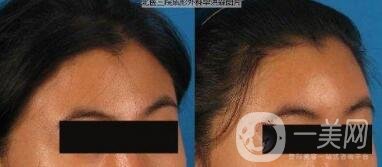 額部填充術