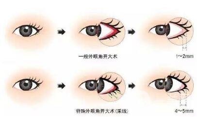 開外眼角會留疤嗎？留疤了怎么辦？