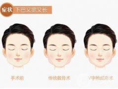 下頜角手術(shù)術(shù)后護(hù)理要注意哪些？