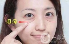 玻尿酸豐淚溝有危險(xiǎn)嗎？能管多久？