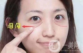 玻尿酸豐淚溝有危險嗎？能管多久？
