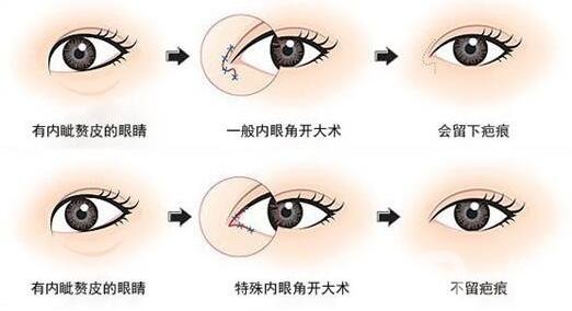 韓式開(kāi)眼角手術(shù)*果怎么樣?看前后圖