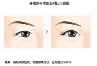韓式開(kāi)眼角手術(shù)*果怎么樣?看前后圖