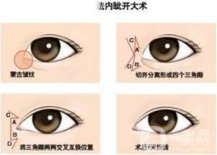 開內(nèi)眼角后遺癥有哪些?術(shù)后需要如何護(hù)理?