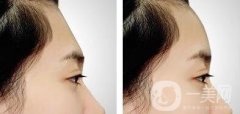 額頭可以整形嗎?不飽滿可以填充嗎?