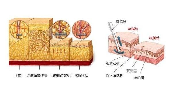 360度吸脂的手術(shù)需要多少錢？