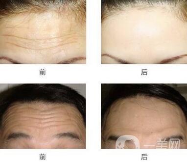 抬頭紋手術(shù)價格