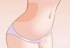 腹壁整形多少錢？費(fèi)用詳細(xì)解說