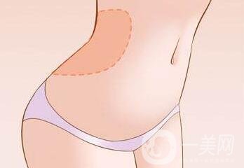 腹壁整形多少錢？費(fèi)用詳細(xì)解說