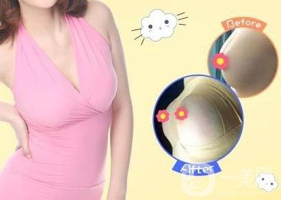 娜高豐胸假體好不好？需要多少錢？