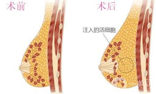 自體細(xì)胞豐胸*果自然嗎？要恢復(fù)多久？