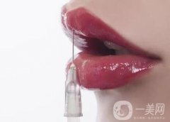 玻尿酸豐唇珠能夠保持多久？需要繼續(xù)注射嗎？