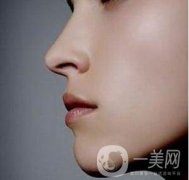 骨粉隆鼻后遺癥是什么樣的？